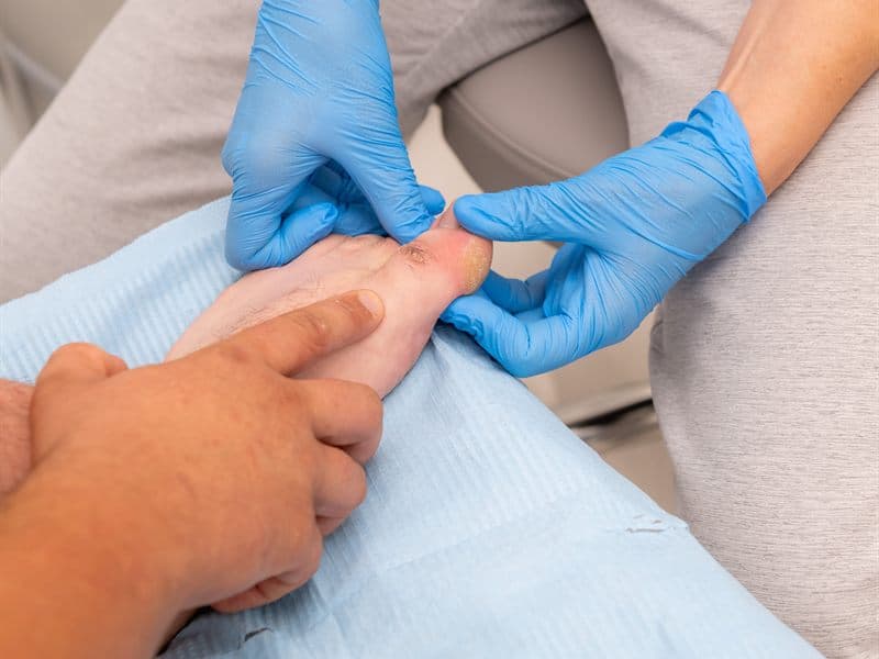 Tratamiento de uñas encarnadas en A Guarda